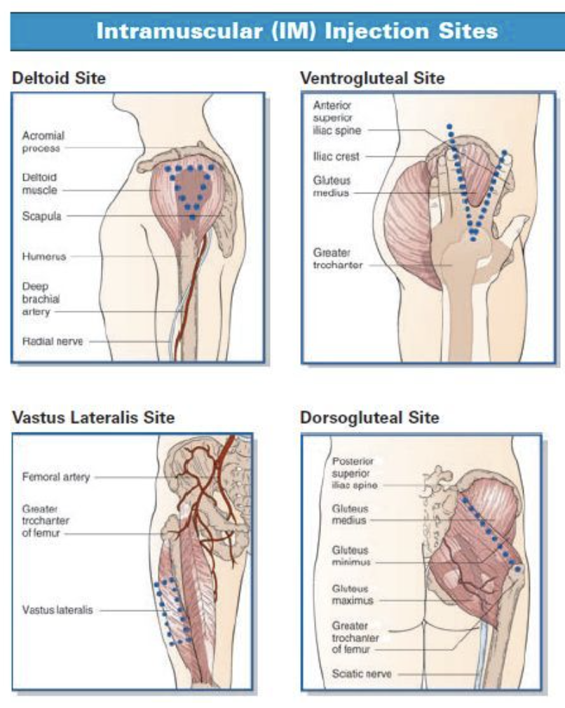Intramuscular injection site planning diagram